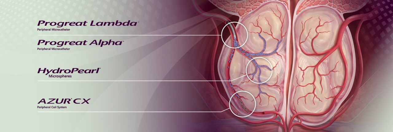 Diagram of pelvic vasculature with highlighted areas indicating placement of Progreat  microcatheters, HydroPearl  embolic microspheres, and AZUR CX coil system.