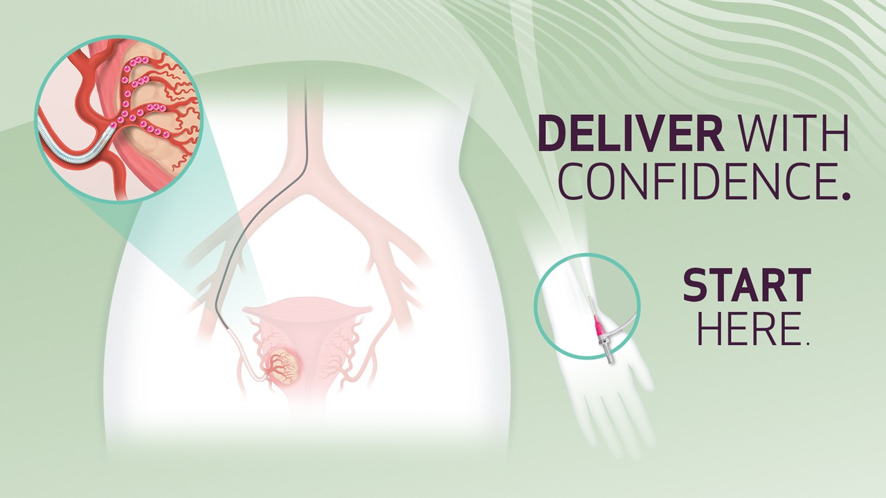 Medical illustration showing pelvic  anatomy with highlighted uterine  arteries and a catheter delivering  embolic material, accompanied by  text that reads “Deliver with  Confidence. Start Here.”