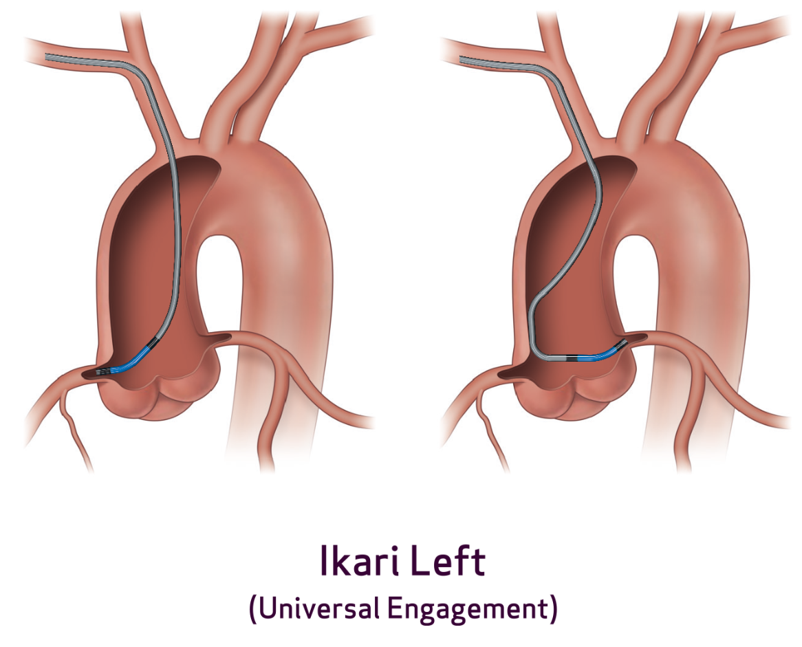 View Heartrail® Ikari Left