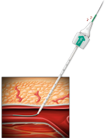 Angio-Seal inserted in an artery